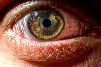 What Your Eyes Are Giving Away about Your Health