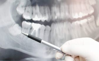 tooth extraction