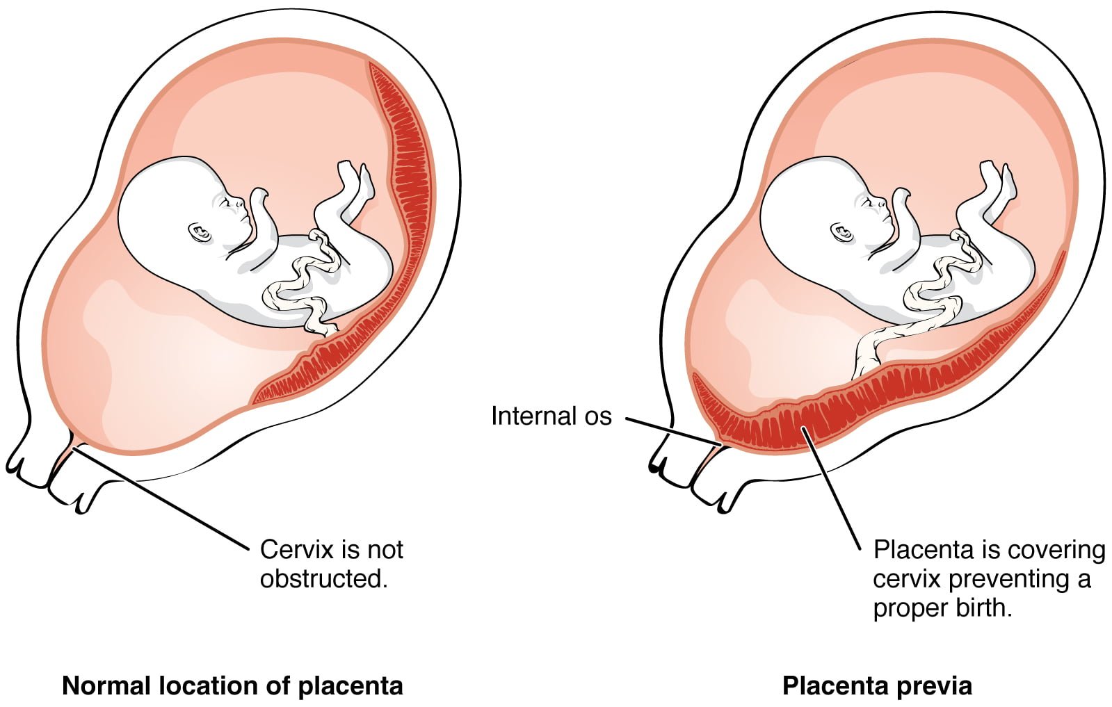 What is placenta previa? - AskDrManny