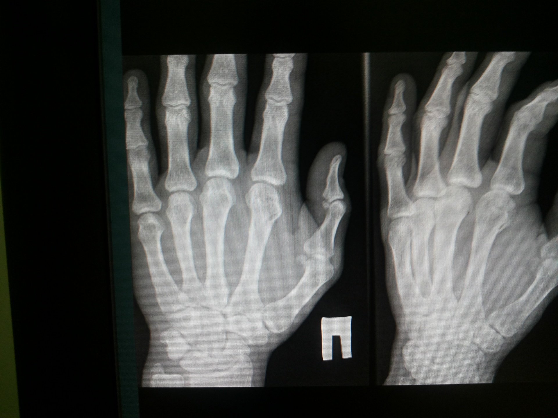 Is It Broken or Sprained? When to Seek Medical Attention : AskDrManny