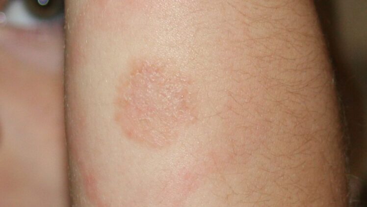 Lyme Disease type Rash on 5 year olds arm. Includes ringworm rash in the center
