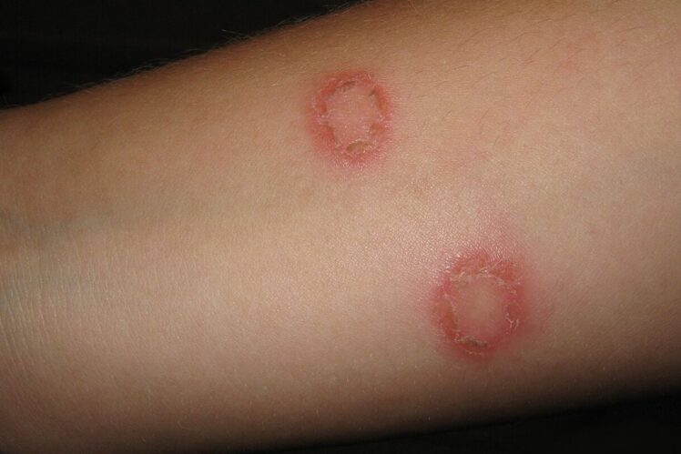 Two lesions associated with ringworm on the forearm