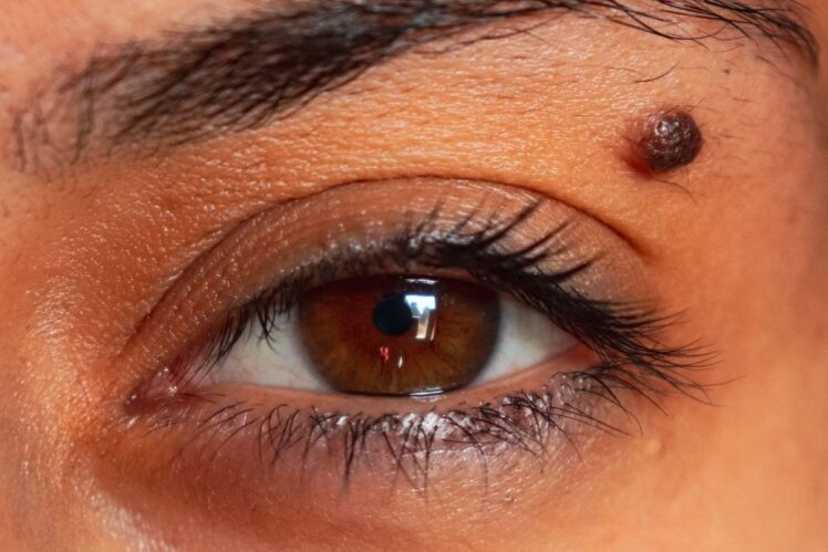 Woman with a mole on her eyelid. 